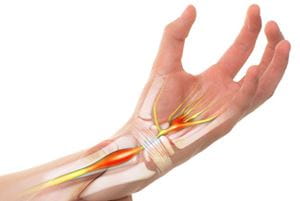 Illustration of inflamed nerves in a hand.