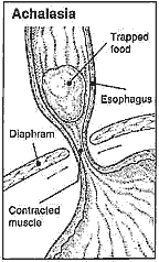 Illustration depicting Achalasia showing trapped food in the esophagus, contracted muscle, and the diaphram.