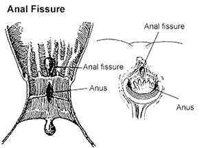 Illustration of an anal fissure.