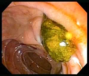 Endoscopic image of a bile duct stone