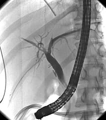 An X-ray image of the biliary tree during an ERCP procedure. 