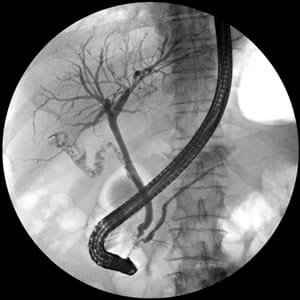 An X-ray image of the biliary tree during an ERCP.
