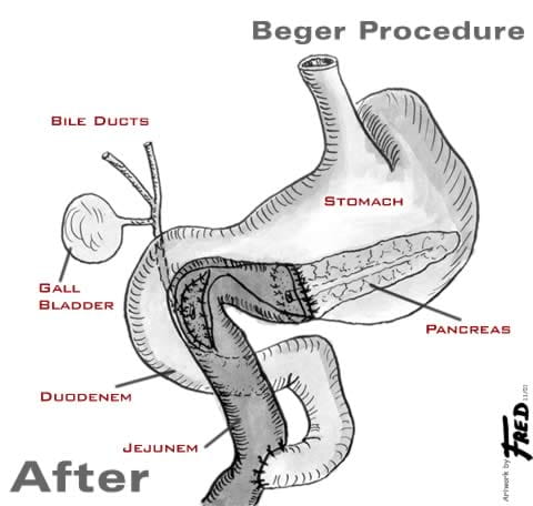 Illustration showing organs after a Beger procedure