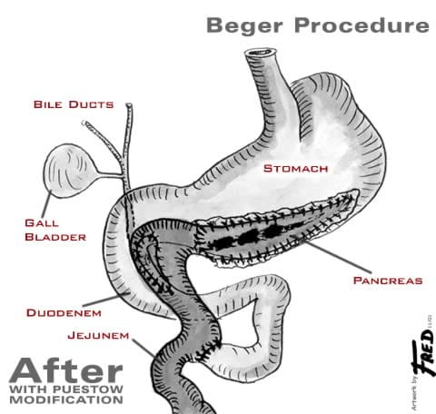 Illustration showing organs after a Beger procedure with Puestow modification