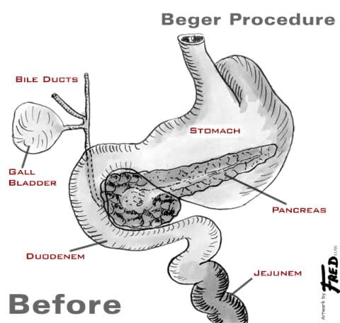 Illustration showing organs prior to a Beger procedure