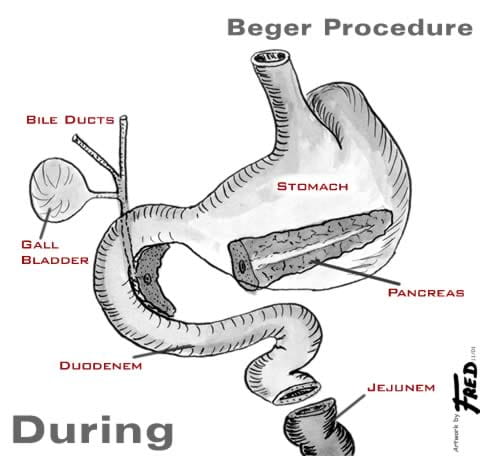 Illustration showing organs during a Beger procedure