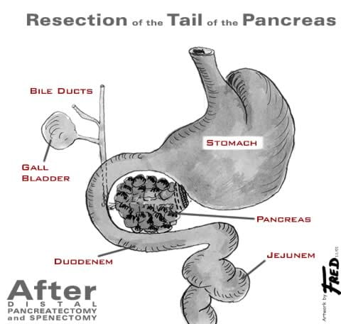 Illustration showing organs after a distal pancreatectomy and spenectomy