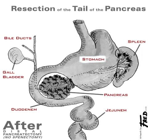 Illustration showing organs after a distal pancreatectomy
