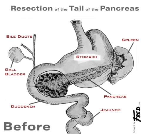 Illustration showing organs prior to a distal pancreatectomy