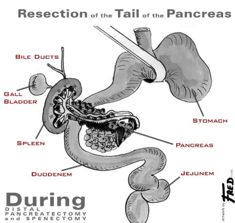 Illustration showing organs during a distal pancreatectomy