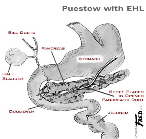 pancreas ehl ddc