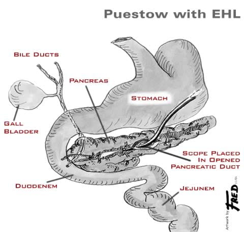 Illustration depicting a Puestow with EHL procedure