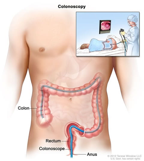 Illustration of a human torso and colon showing where the colonoscope goes through the body. 