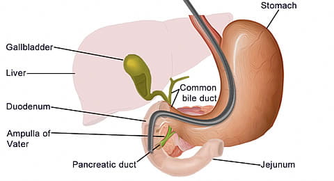 Illustration depicting an ERCP procedure