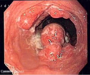 An endoscopic image showing esophageal adenocarcinoma.