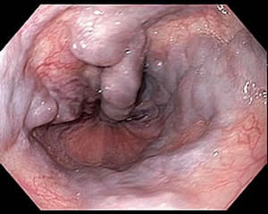 Endoscopic view of varicose veins in the esophagus.