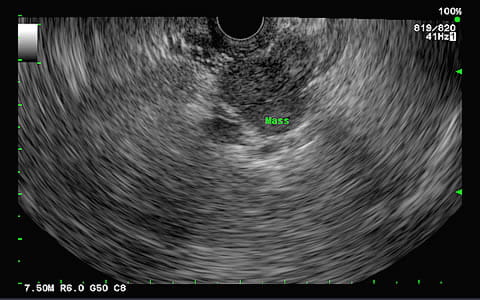 An EUS image showing a mass adjacent to the stomach.