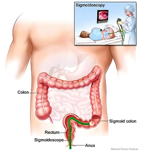 Sigmoidoscope inserted into the sigmoid colon through the anus and rectum.