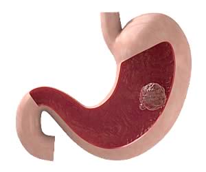 An illustration of a gastric mass.
