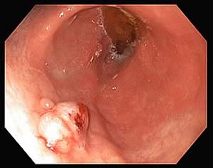 image of a gastric mass