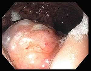 image of a gastric mass