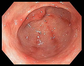 Gastritis, as indicated by the inflammation and damage to the stomach lining.