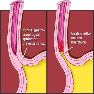 Illustration of GERD where acid in your stomach flows up into your esophagus.