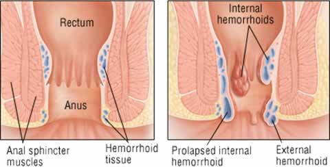 labeled illustration of internal and external hemorrhoids
