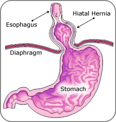 Gastroesophageal Reflux Disease Gerd Musc Health Charleston Sc
