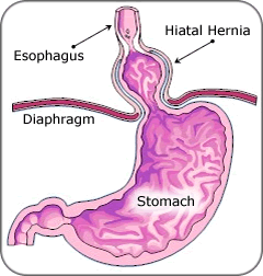An illustration depicting a hiatal hernia.