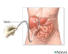 An illustration showing infusion of islet cells into the liver.