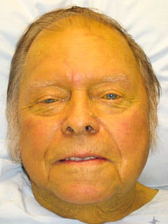 A jaundiced face of an elderly male.