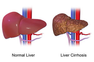 Illustration of a normal liver next to a liver with cirrhosis.