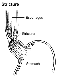 Illustration of peptic stricture depicting the esophagus, a stricture in the esophagus and the stomach