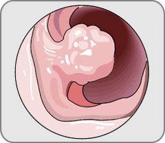 An illustration of a polyp on the colon's inner lining