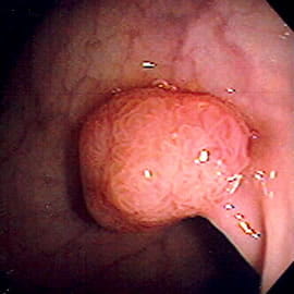 An endoscopic image of a benign, or non-cancerous, polyp.