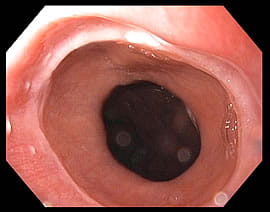 A Schatzki's ring in the esophagus