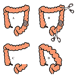 Illustration depicting treatment of colon cancer that reads: (A) a cancer in the sigmoid colon; (B) during the operation, the surgeon cuts above and below the tumor to isolate it; (C) isolated section is then removed; (D) upper and lower parts of the bowel are reconnected.