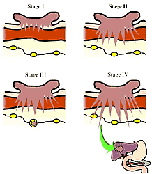 Illustration depicting the four stages of colorectal cancer