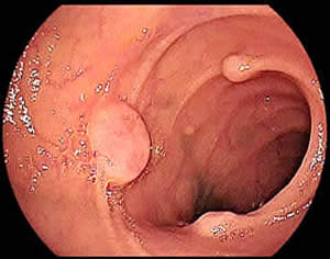 An endoscopic image showing multiple tumors in part of the small intestine.