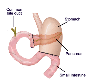 An illustration depicting digestive organs following a Whipple procedure.