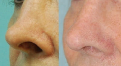 Alar retraction before and after surgery
