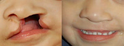 Before and after cleft lip repair 1