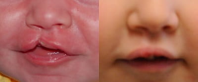 Before and after cleft lip repair 2