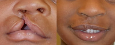 Before and after cleft lip repair 3