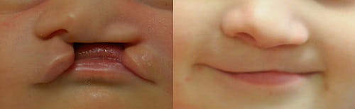 Before and after cleft lip repair 4