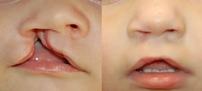 Before and after cleft lip repair 5