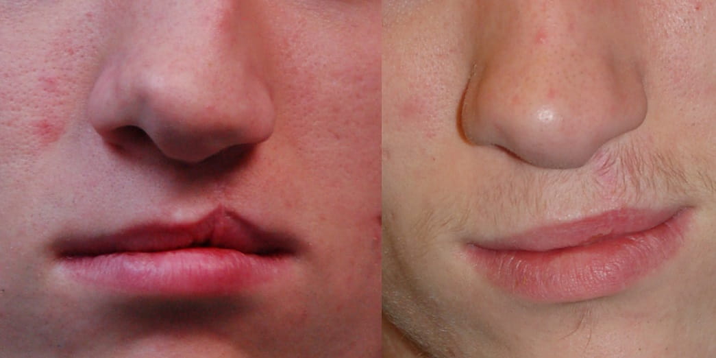 Before and after cleft lip revision surgery