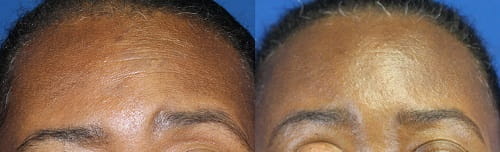 Before and after endoscopic brow lift