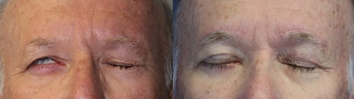 Before and after eyelid weight